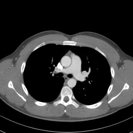 Axial CT of the chest, mediastinal window